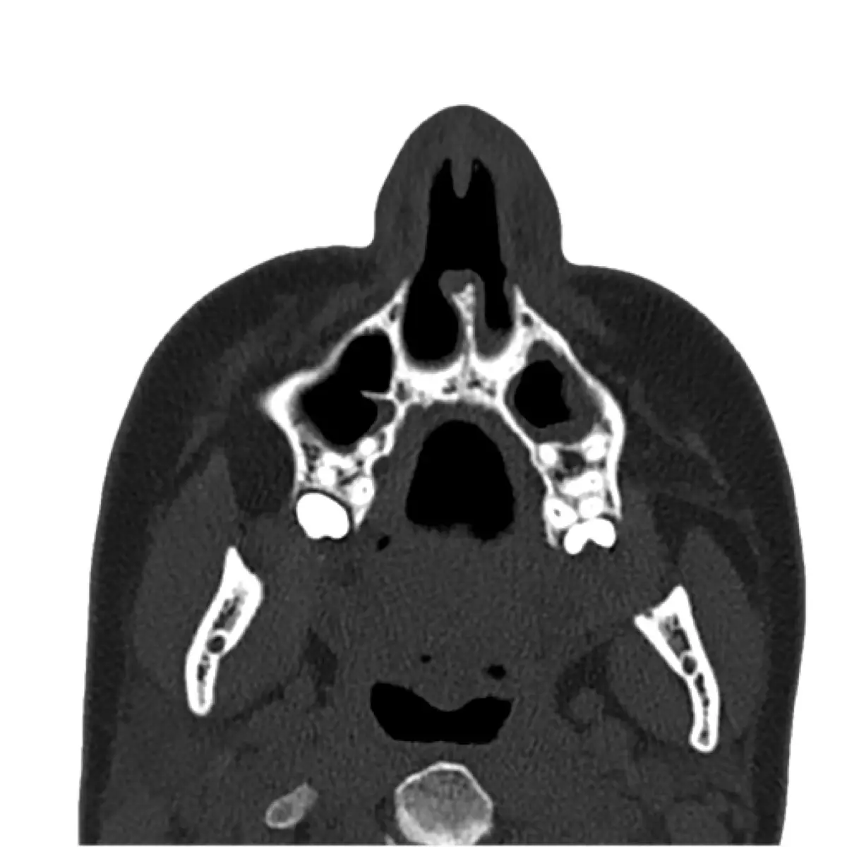 Aksijalni CT prikaz anatomije sinusa