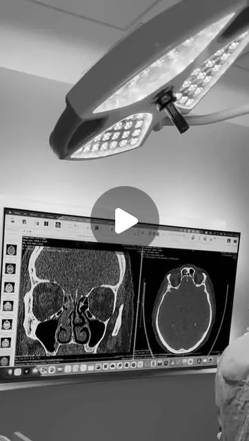 Video: čitanje CT-a sinusa